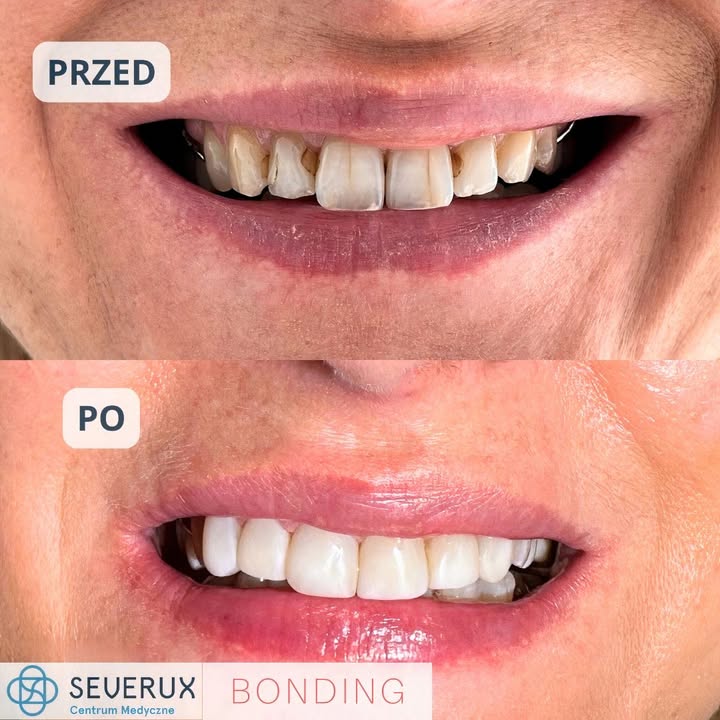 Serio ❓ To te same zęby ⁉️ 😲 Trudno uwierzyć, ale tak – to efekt pracy lek. dent. Marleny Biel i możliwości, jakie daje bonding 💥