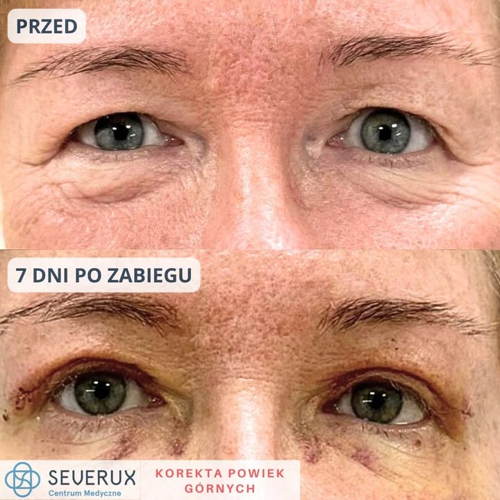 Precyzja, delikatność i szybkie gojenie – efekty zabiegu blefaroplastyki powiek gornych lek. Zuzanny Korbeckiej już po 7 dniach 👁✨ Brawo 😍