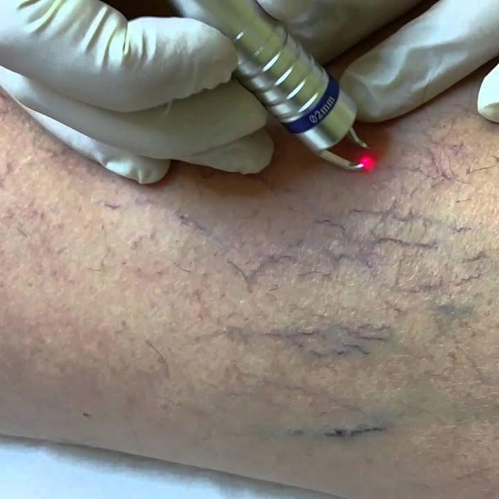 VELAS 940nm for leg vein