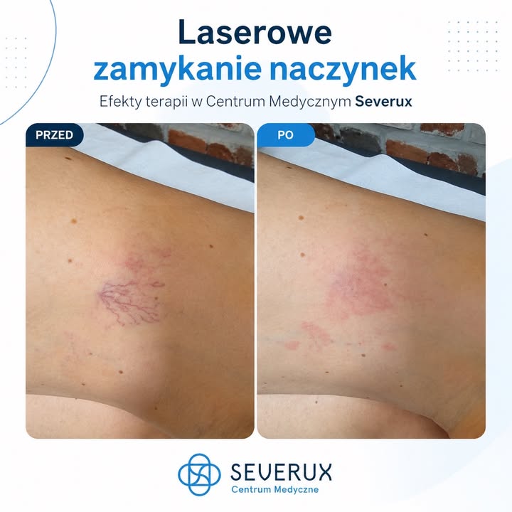 𝗟𝗮𝘀𝗲𝗿𝗼𝘄𝗲 𝘇𝗮𝗺𝘆𝗸𝗮𝗻𝗶𝗲 𝗻𝗮𝗰𝘇𝘆𝗻𝗲𝗸 𝘄 𝗽𝗿𝗮𝗸𝘁𝘆𝗰𝗲 ✨  Dziś w relacji wspominaliśmy o laserowym zamykaniu naczynek - teraz pokazujemy efekt zabiegu wykonanego wczoraj przez 𝗹𝗲𝗸. 𝗔𝗴𝗻𝗶𝗲𝘀𝘇𝗸𝗲̨ 𝗣𝗮𝗷𝗮̨𝗸.  Zabieg wykonywany jest bezpiecznie, przy użyciu nowoczesnego lasera diodowego 𝗩𝗲𝗹𝗮𝘀.  Ceny zaczynają się już 𝗼𝗱 𝟭𝟱𝟬 𝘇ł.  📍 CM Severux Świętochłowice, ul. Sikorskiego 1
📞 Rejestracja: 510 809 408  #zamykanienaczynek #laseroterapia #Severux #Świętochłowice