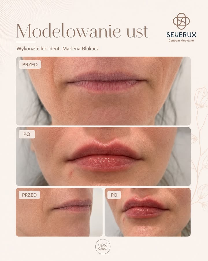 💋 Modelowanie ust nie oznacza jednego, powtarzalnego efektu. – Image 1