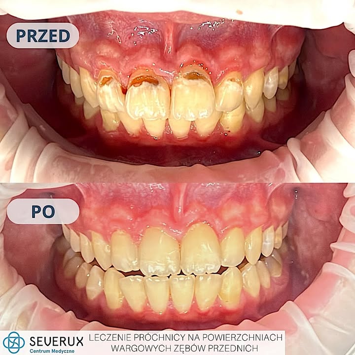 Za tym efektem stoi staranna praca naszej 𝗹𝗲𝗸. 𝗱𝗲𝗻𝘁. 𝗭𝘂𝘇𝗮𝗻𝗻𝘆 𝗢𝗹𝘀𝘇𝗮𝗸 🦷💙  Na zdjęciach przedstawiamy stan przed i po 𝗹𝗲𝗰𝘇𝗲𝗻𝗶𝘂 𝗴łę𝗯𝗼𝗸𝗶𝗲𝗷 𝗽𝗿ó𝗰𝗵𝗻𝗶𝗰𝘆 𝗻𝗮 𝗽𝗼𝘄𝗶𝗲𝗿𝘇𝗰𝗵𝗻𝗶𝗮𝗰𝗵 𝘄𝗮𝗿𝗴𝗼𝘄𝘆𝗰𝗵 𝘇ę𝗯ó𝘄 𝗽𝗿𝘇𝗲𝗱𝗻𝗶𝗰𝗵. Usunięcie zmian próchnicowych i odbudowa zębów pozwoliły przywrócić im naturalny wygląd.